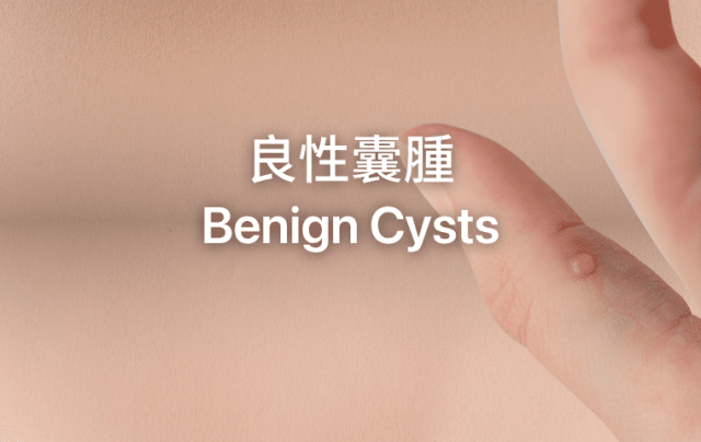 Benign Cyst